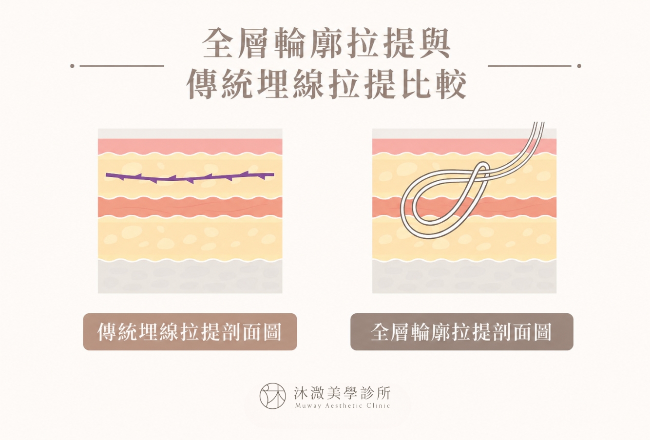 傳統埋線與全層輪廓拉提迴繞固定比較