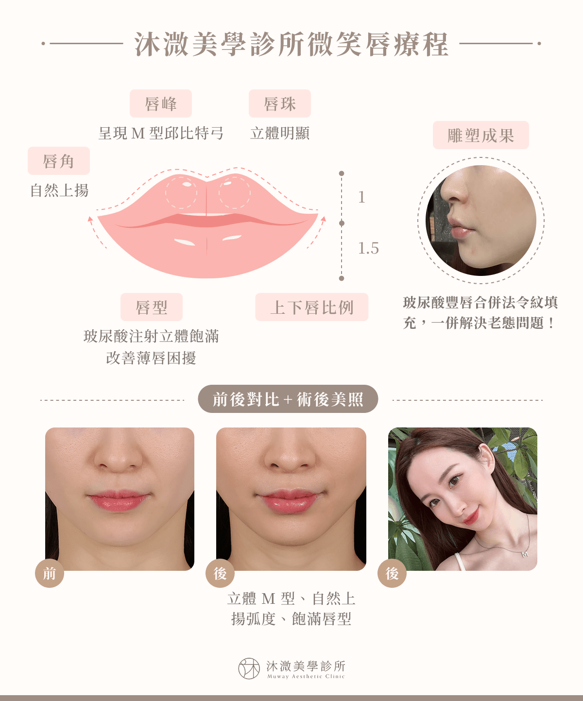 沐溦美學診所微笑唇療程