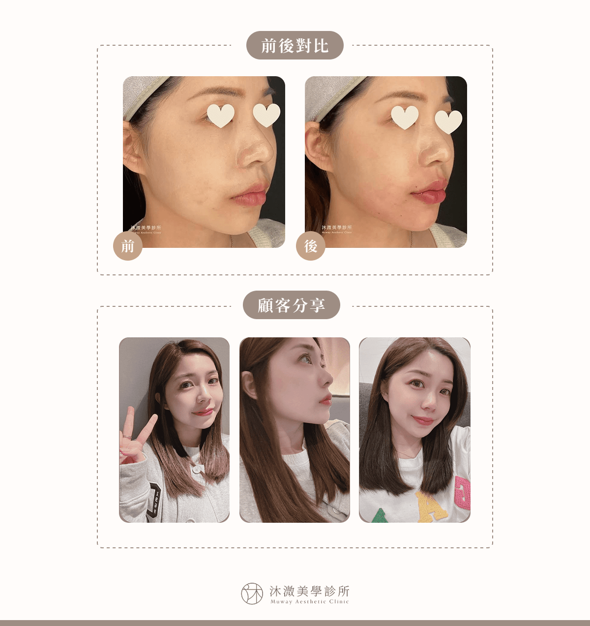 案例 3：唇珠唇峰自然雕塑