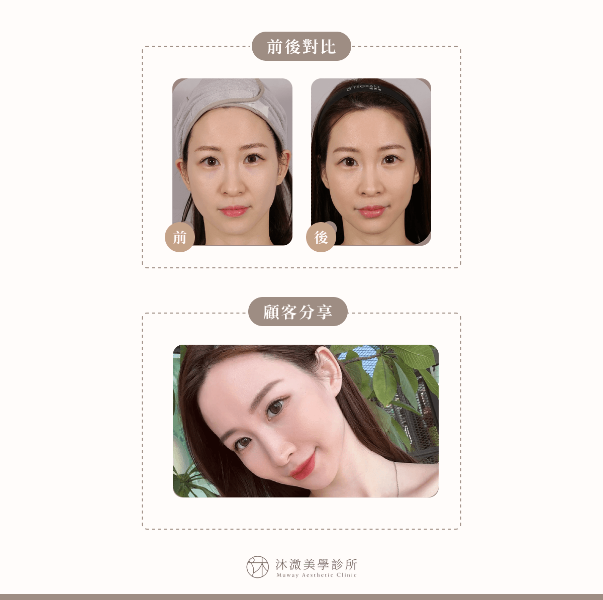 案例 6：唇型雕塑＋法令紋複合精雕