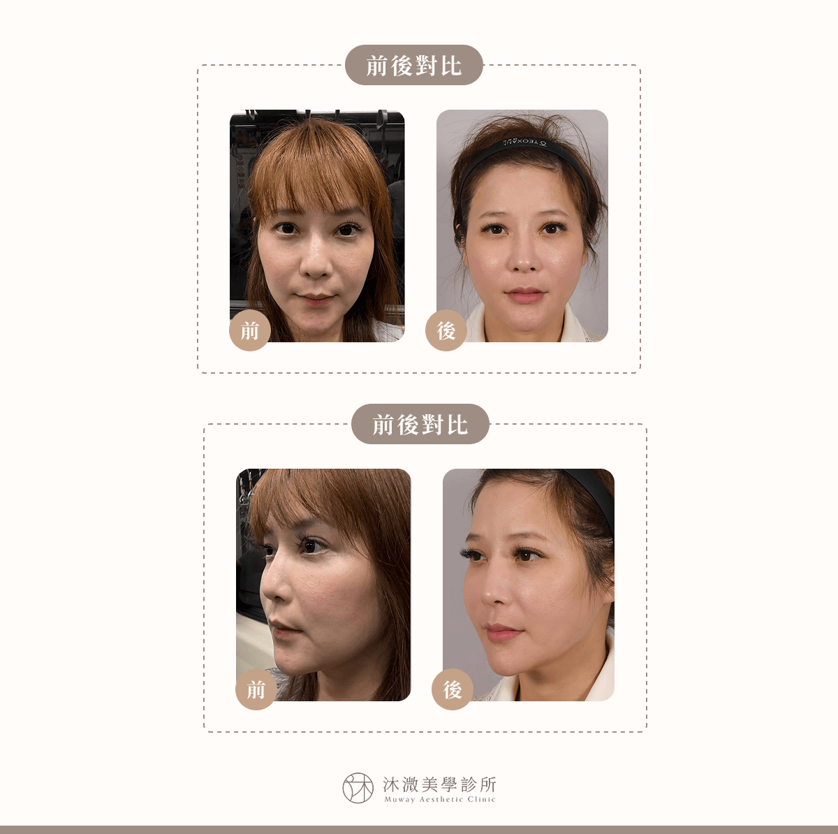 案例 7：唇型雕塑＋長效跨層次迴繞拉提複合治療