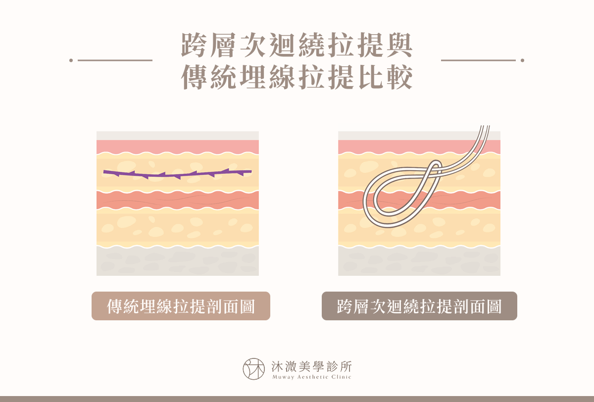 跨層次迴繞拉提與傳統埋線拉提比較