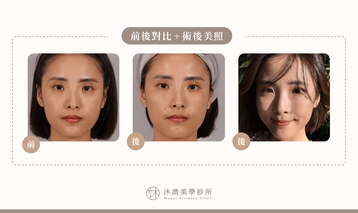 沐溦美學診所淚溝填補案例