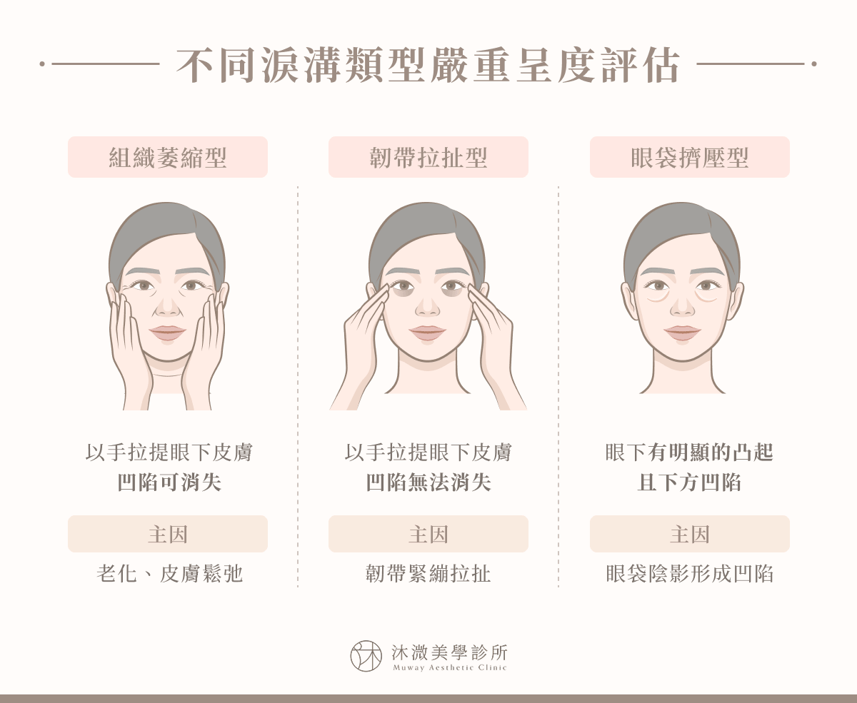 不同淚溝類型嚴重程度評估