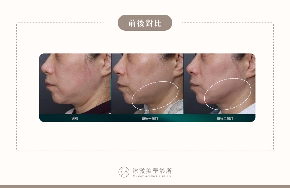 原廠案例 5：俐落下頷線條打造