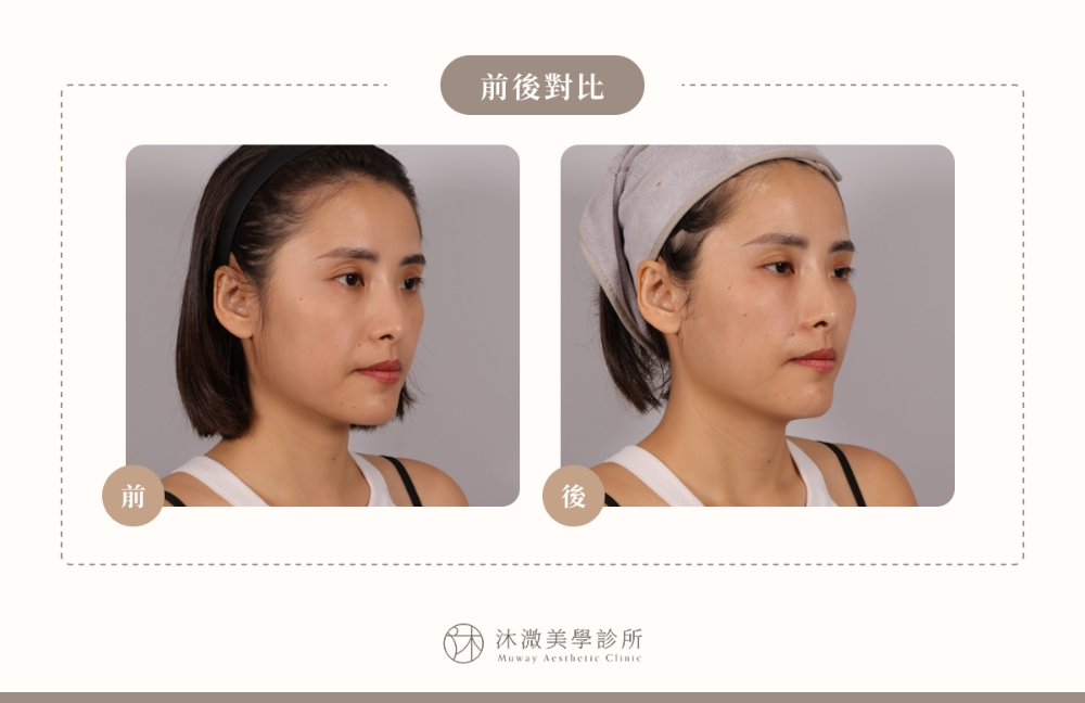 案例 3：鼻基底凹陷填補