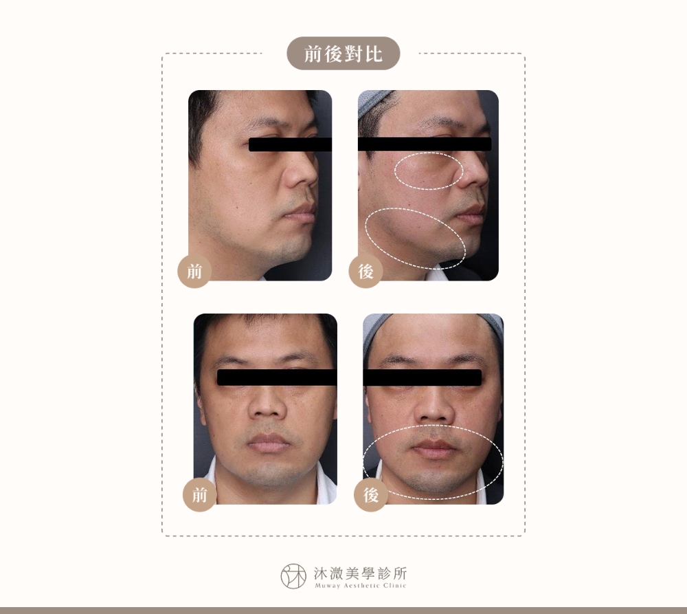 原廠案例 3：中下臉組織拉提