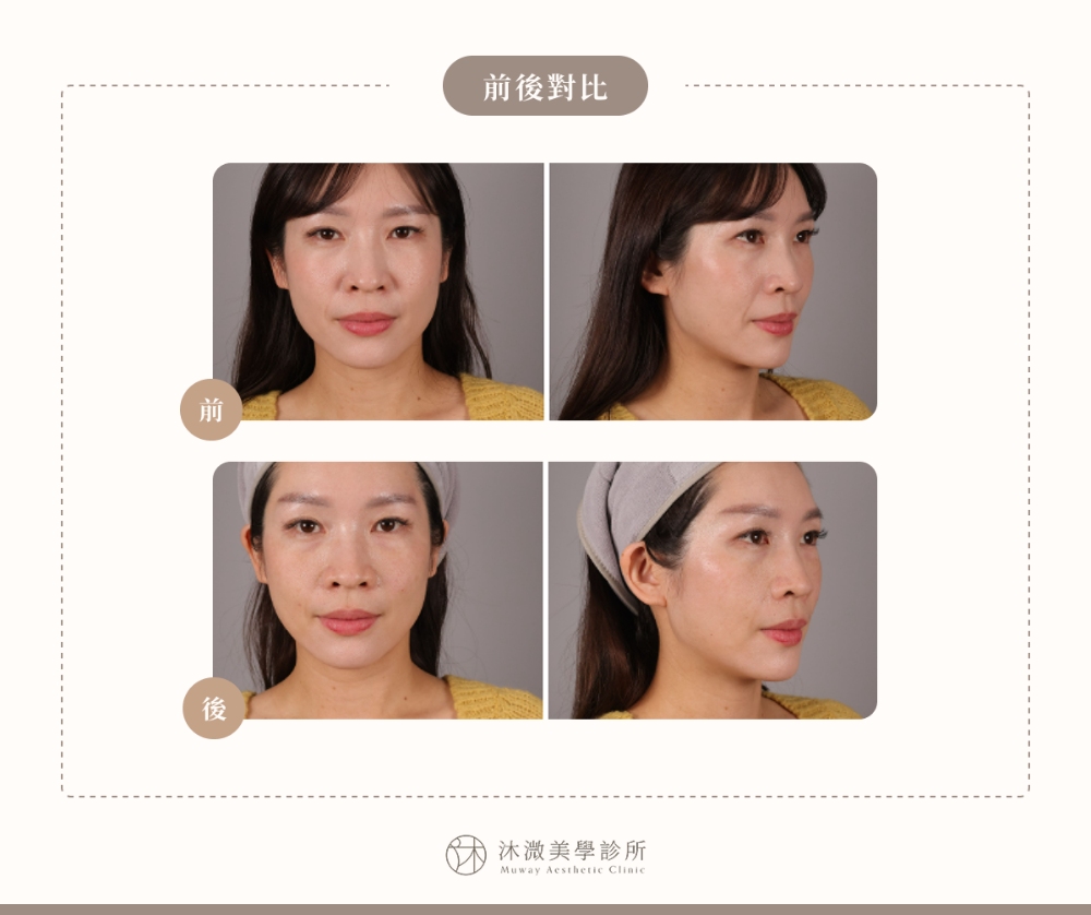 案例 1：鼻唇溝凹陷填補