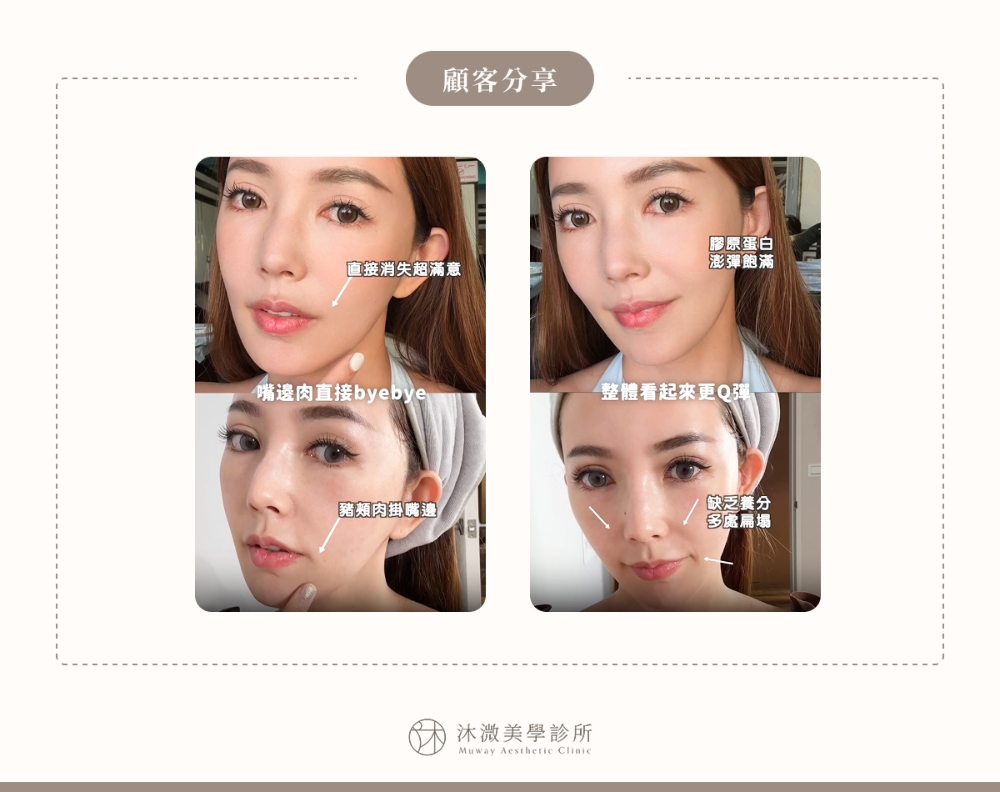 沐溦美學診所案例 2：重塑時尚精緻輪廓線
