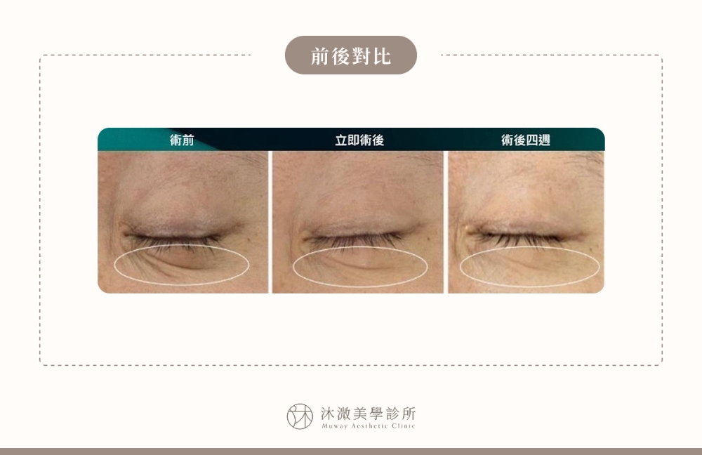 原廠案例 1：眼周細紋改善