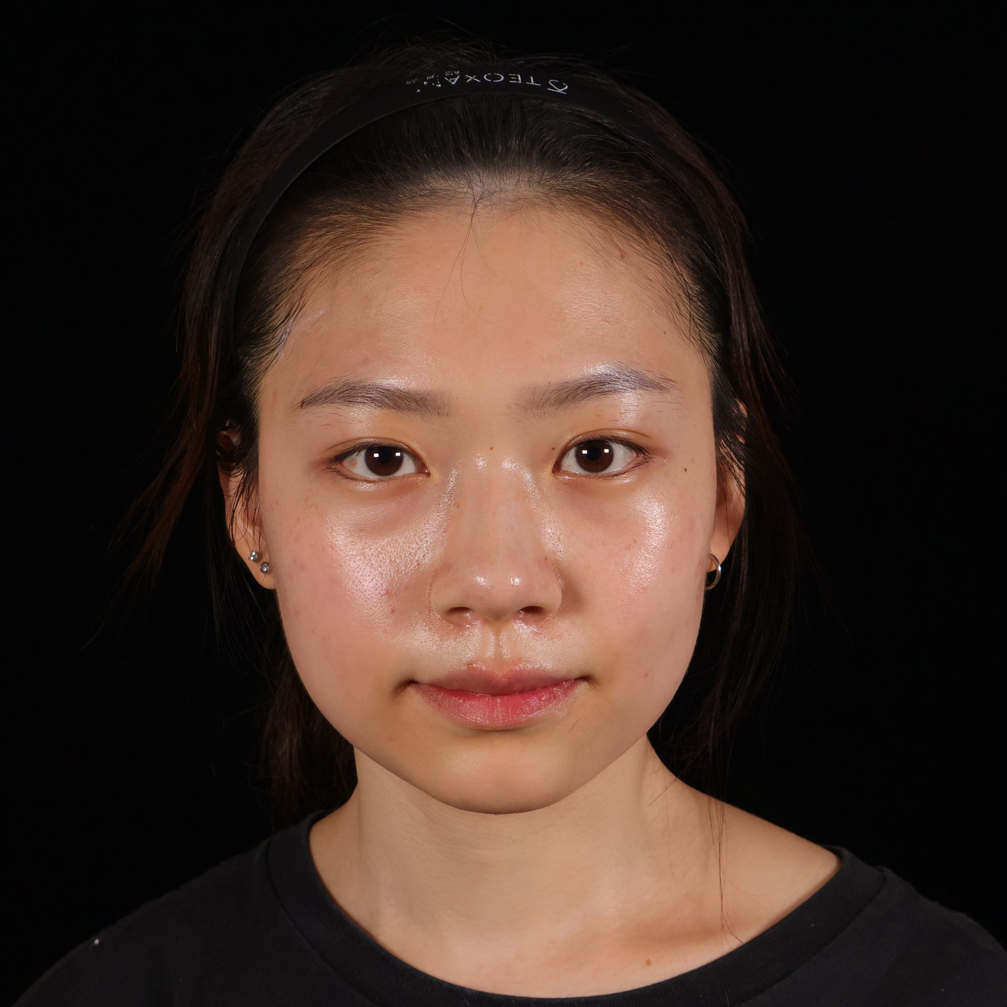 玻尿酸淚溝案例正面眼下與中臉輪廓紀錄