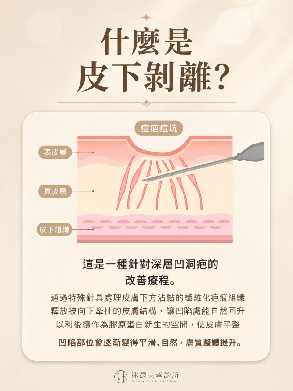 凹痘疤皮下剝離鬆解疤底纖維與釋放凹陷組織示意