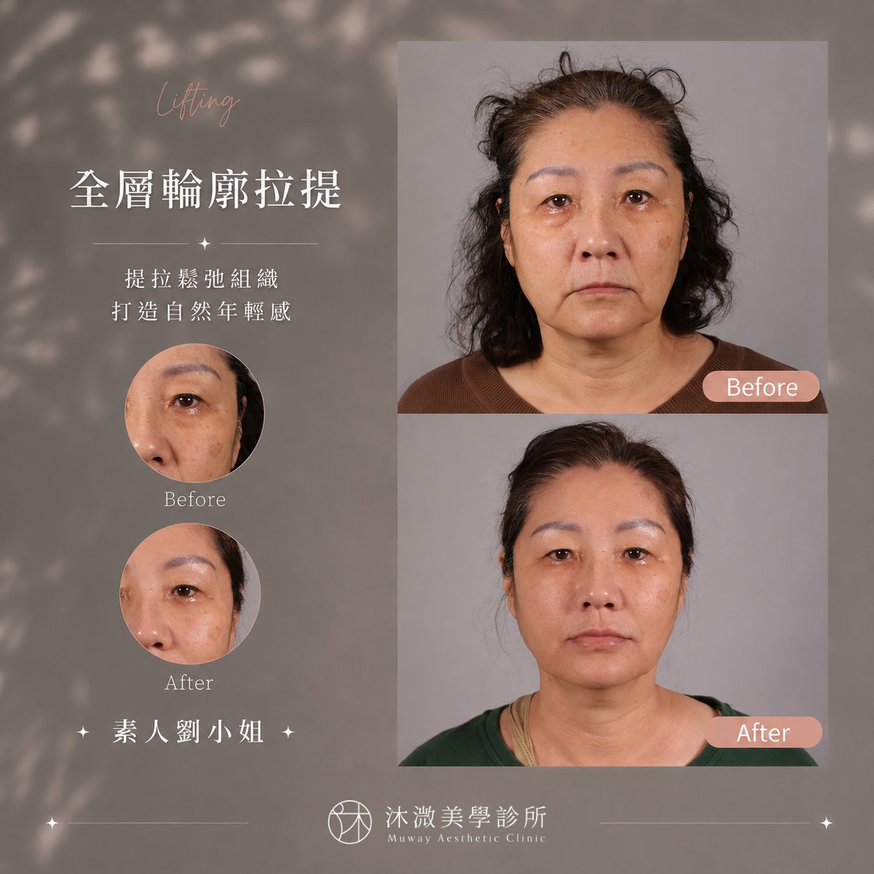 全層輪廓拉提療程前後對比