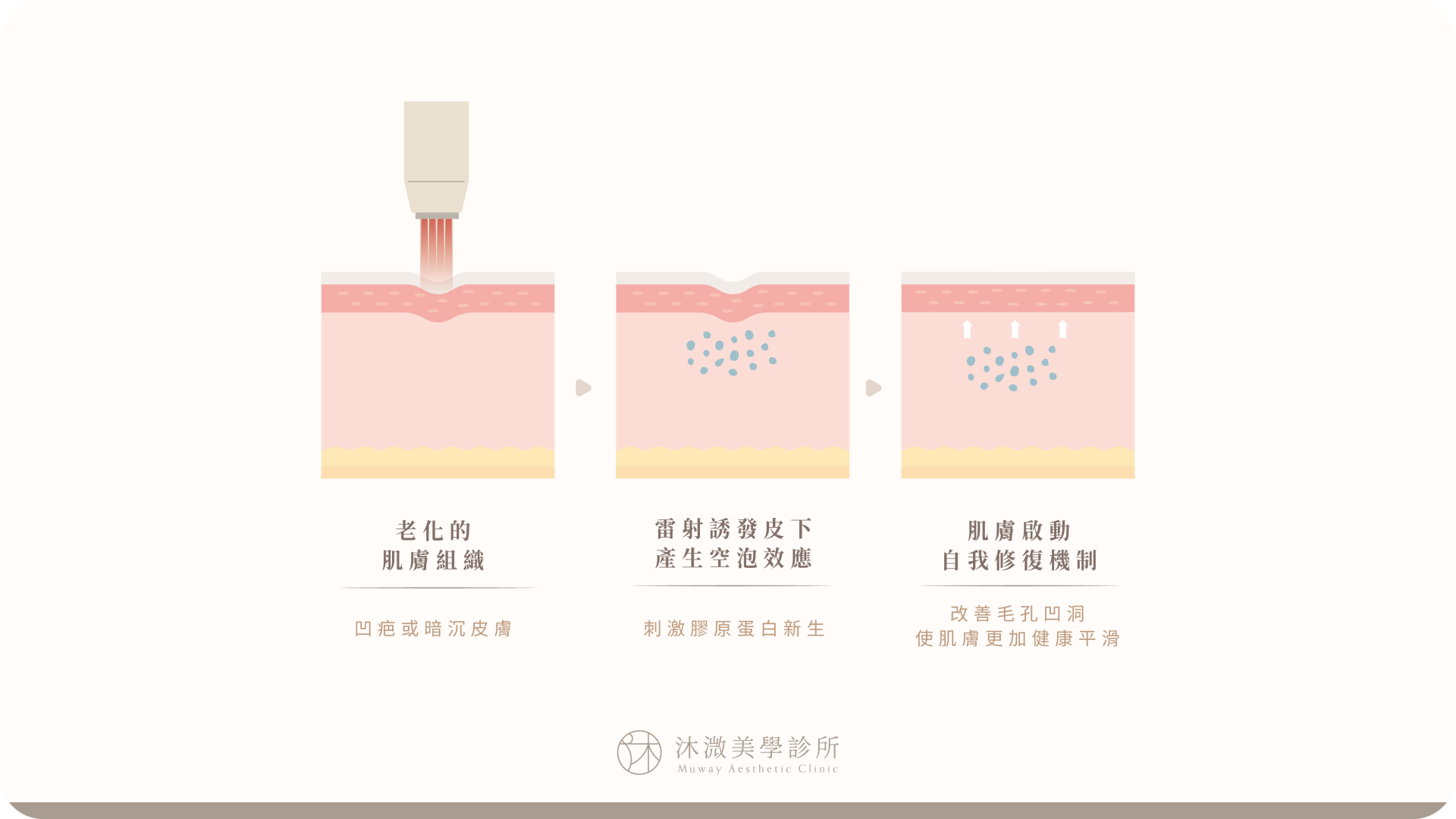 PICOCARE HEXA 智能聚焦透鏡與毛孔紋理治療示意