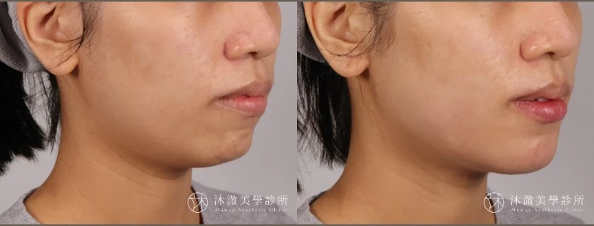素人T小姐下巴填充術前術後側面輪廓比較