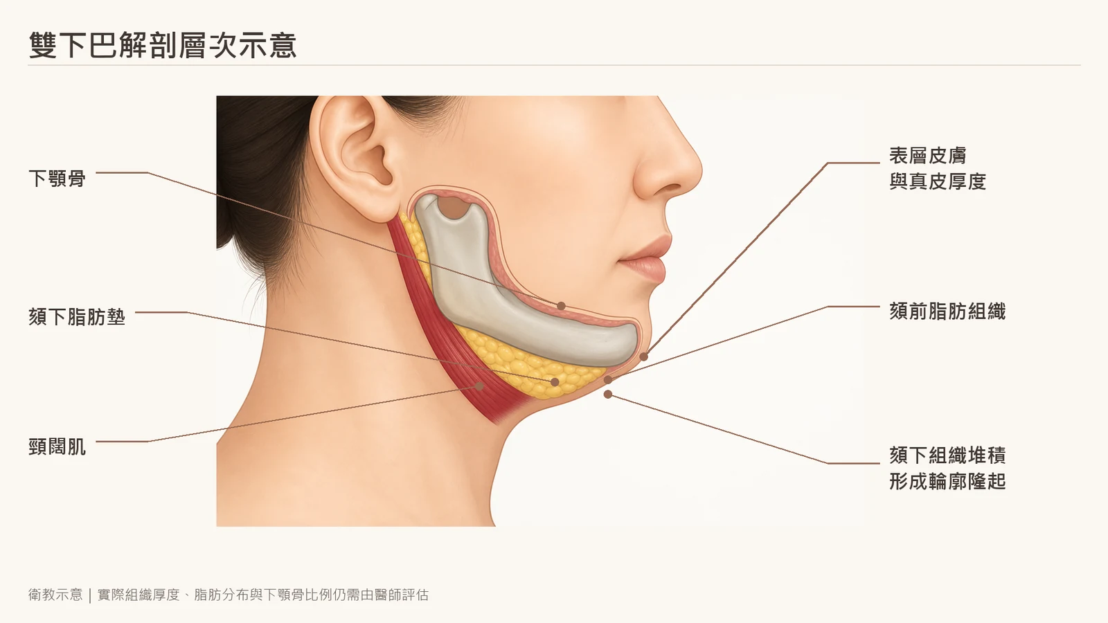 雙下巴下臉與頦下皮膚、脂肪、頸闊肌及下顎骨解剖層次示意