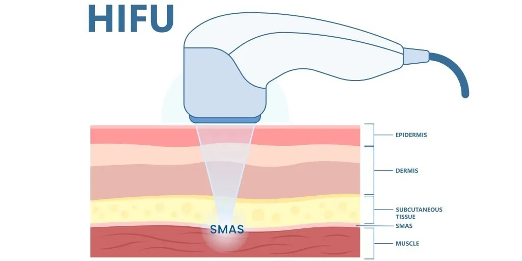 HIFU聚焦超音波作用至皮下組織與SMAS筋膜層示意圖