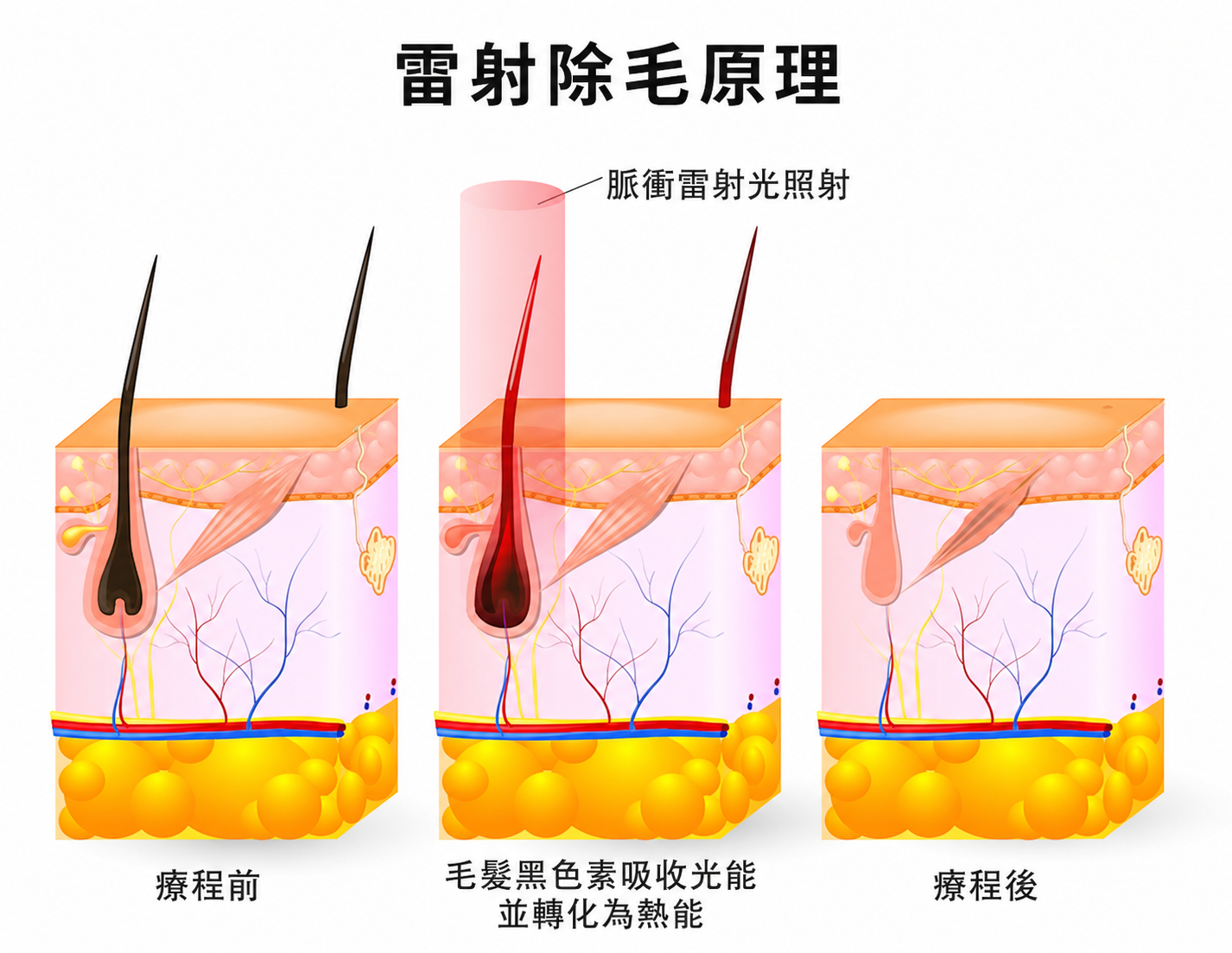 雷射除毛脈衝光黑色素吸收熱能原理