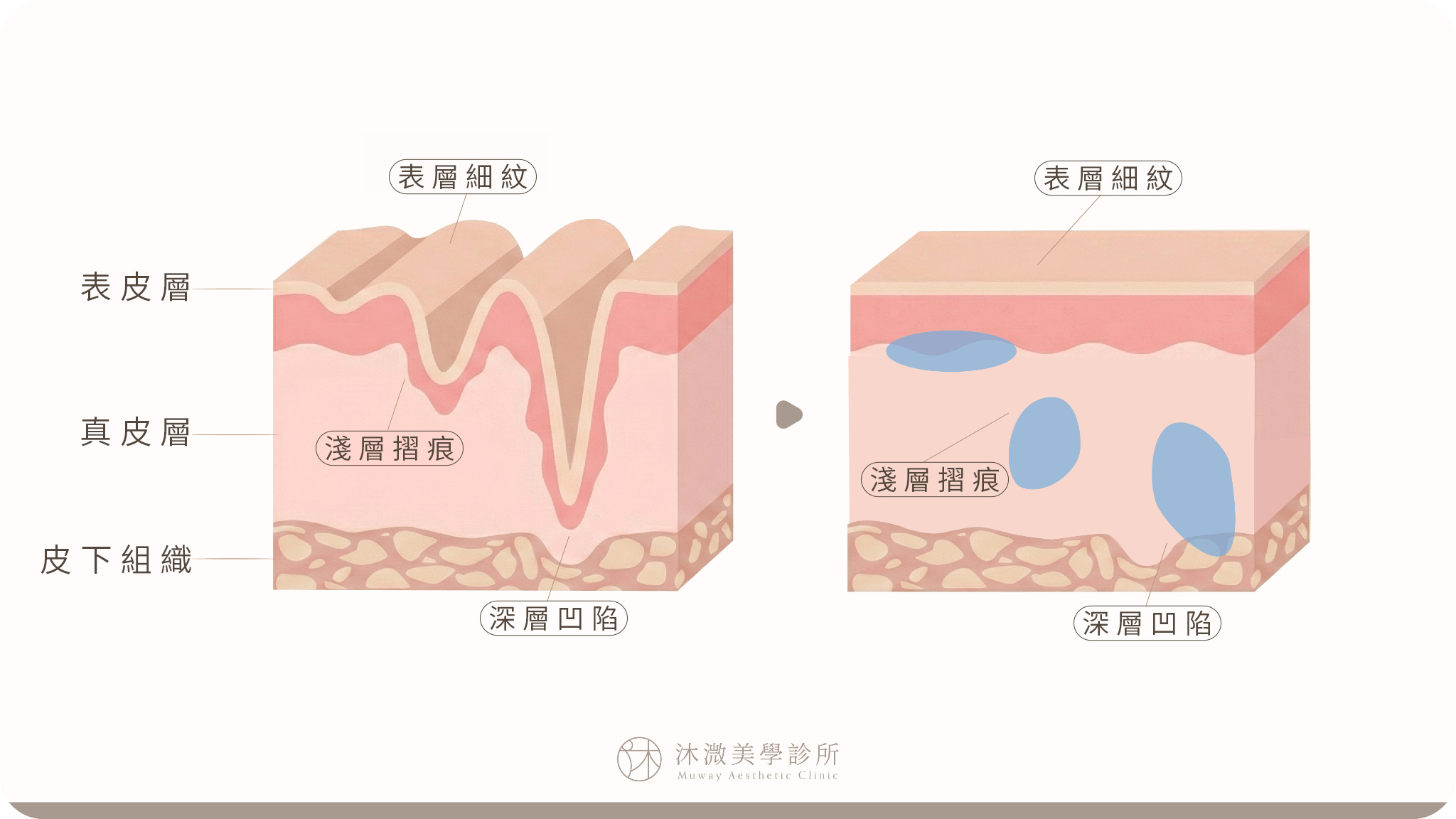 玻尿酸依皮膚層次支撐凹陷與修飾輪廓示意圖