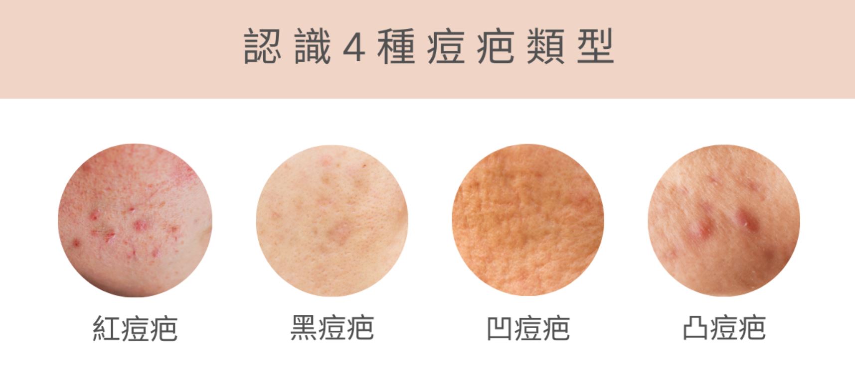紅痘印、黑痘印、凹痘疤與凸痘疤四種類型外觀比較