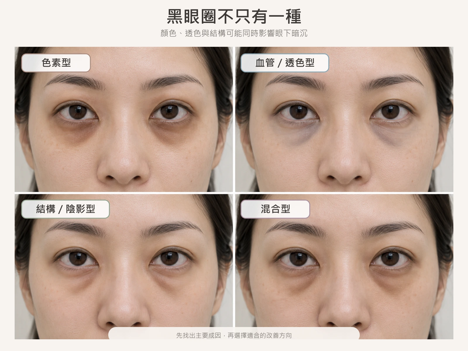 色素型、血管透色型、結構陰影型與混合型黑眼圈比較