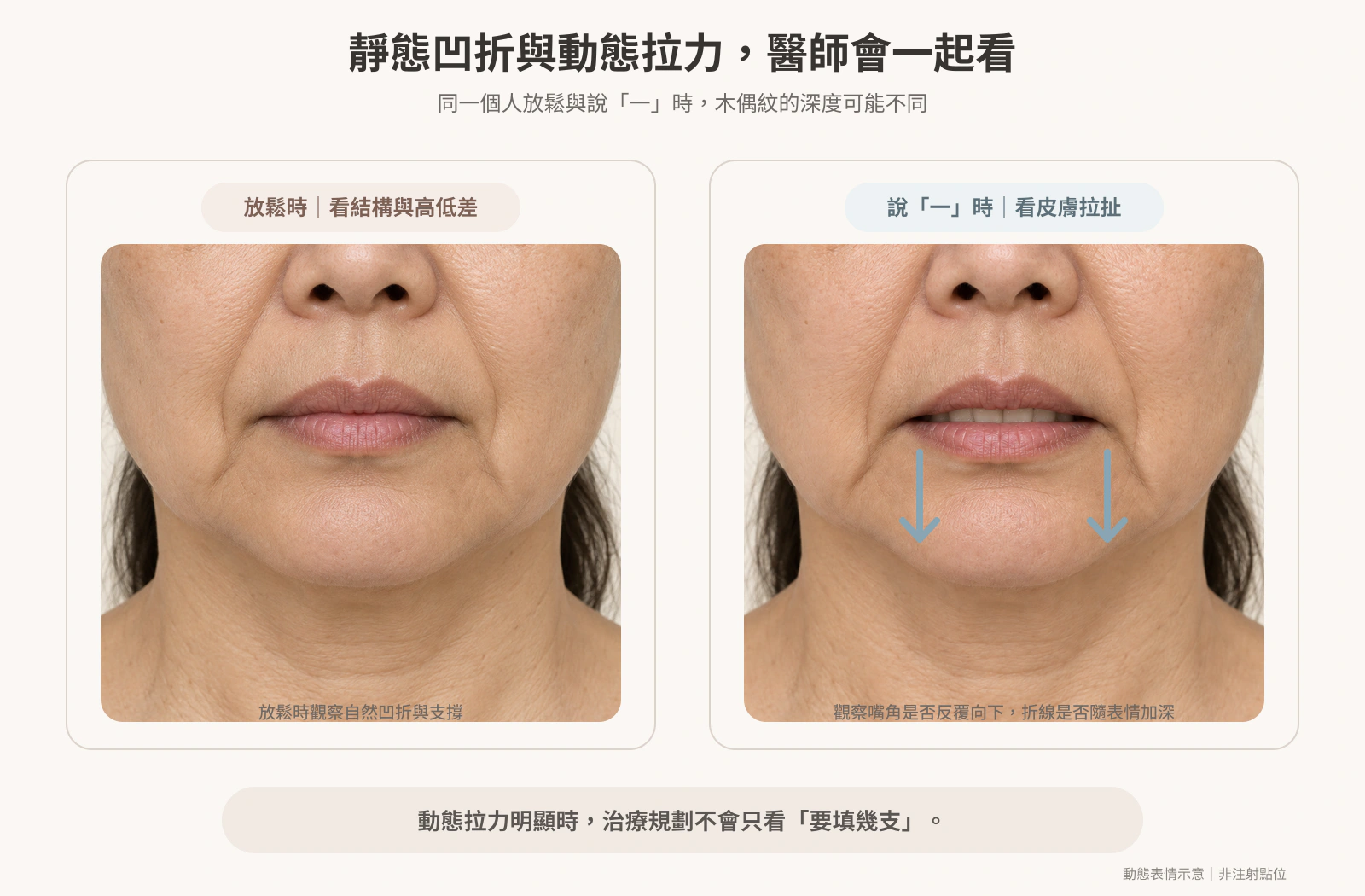 放鬆與說話時觀察木偶紋靜態凹折及動態拉力